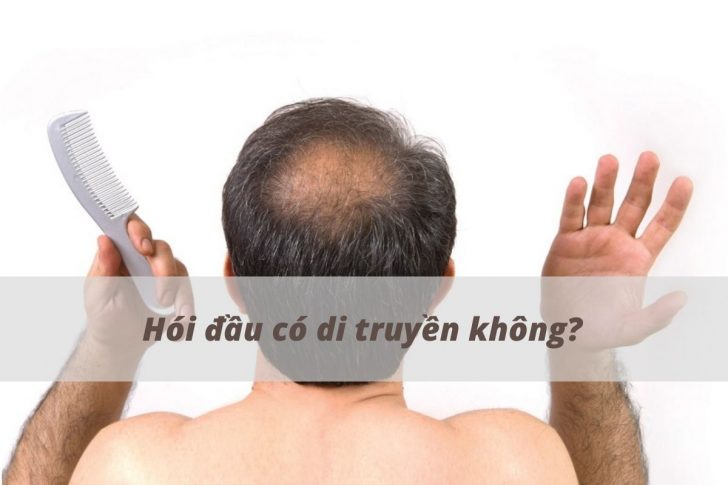 Hói đầu có di truyền không? Gallery 2