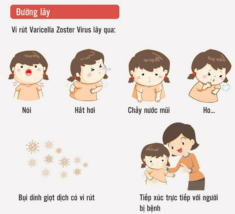 Nguyên nhân gây bệnh thủy đậu là gì? Gallery 2