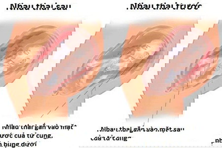 Nhau thai bám mặt sau là con trai: Sự thật hay chỉ là lời đồn? Gallery 1