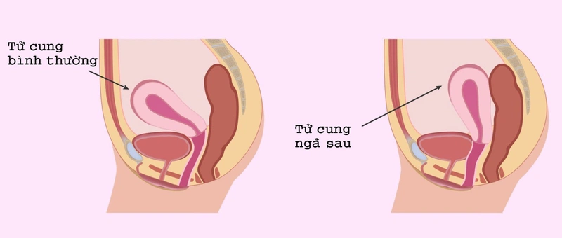 Tử cung ngả trước là con trai hay gái? Gallery 1