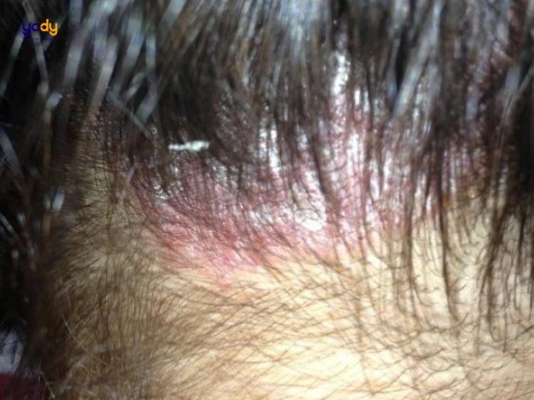 Nhuộm tóc bị rát da đầu: Nguyên nhân và cách khắc phục