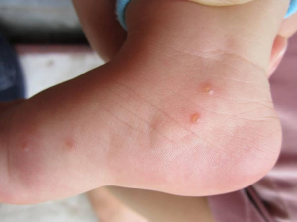 Nổi Bọng Nước Ở Chân: Nguyên Nhân, Cách Điều Trị Và Phòng Ngừa