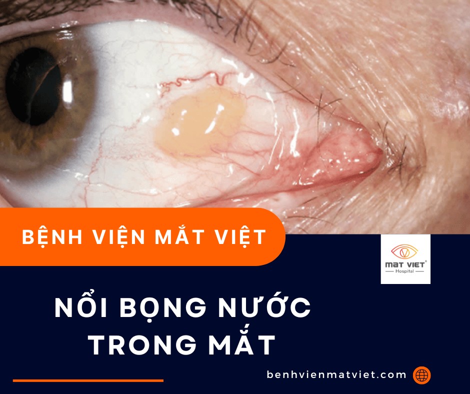 Nổi Bọng Nước Trong Mắt