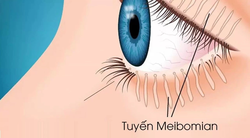 Nổi cục trong mí mắt dưới là gì?