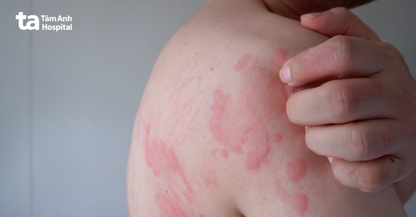 Nổi Đốm Đỏ Trên Người Ngứa: Nguyên Nhân và Cách Điều Trị