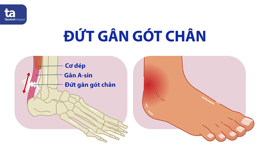 Nối gân chân bao lâu thì khỏi? Gallery 2