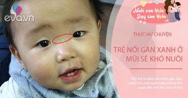 Nổi Gân Xanh Trên Trán Ở Trẻ Em: Nguyên Nhân Và Cách Xử Lý