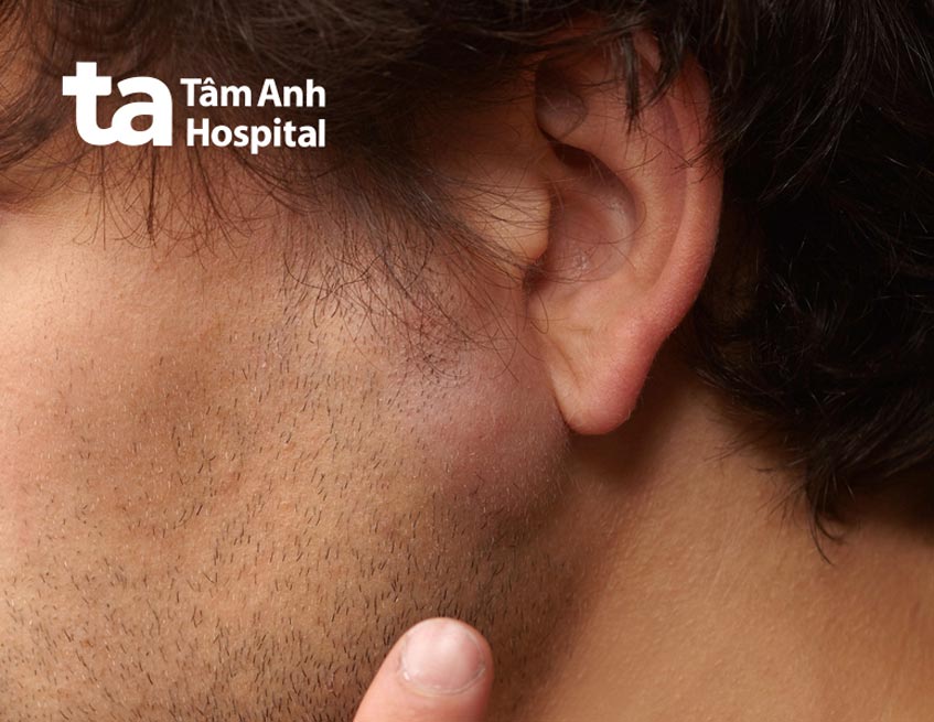 Nổi hạch ở má gần tai phải: Nguyên nhân và cách xử trí