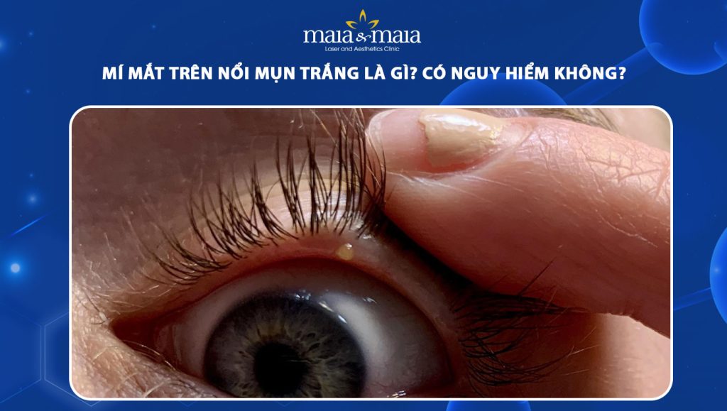 Nổi Hạt Trắng Ở Mí Mắt Trên: Nguyên Nhân Và Cách Điều Trị