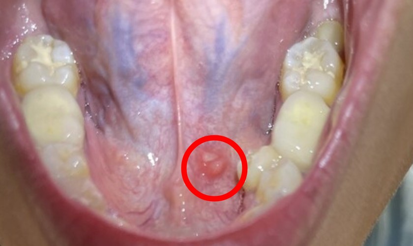Nổi Hột Dưới Lưỡi: Nguyên Nhân, Triệu Chứng Và Cách Điều Trị