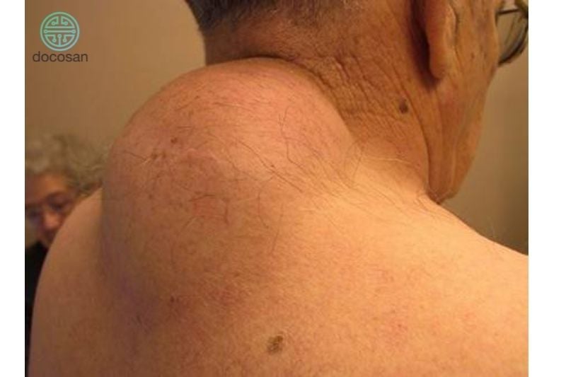 Khối U Sau Gáy: Nguyên Nhân, Triệu Chứng Và Điều Trị