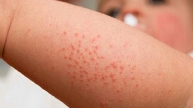 Nổi Mẩn Đỏ Li Ti: Nguyên Nhân, Triệu Chứng và Cách Điều Trị