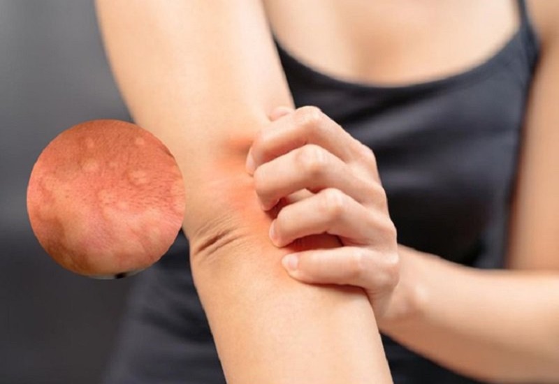 Nổi Mẩn Đỏ Ngứa Về Đêm