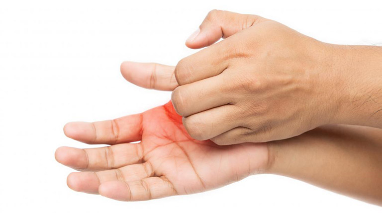 Nổi Mẩn Ngứa Lòng Bàn Tay, Bàn Chân: Nguyên Nhân và Cách Điều Trị