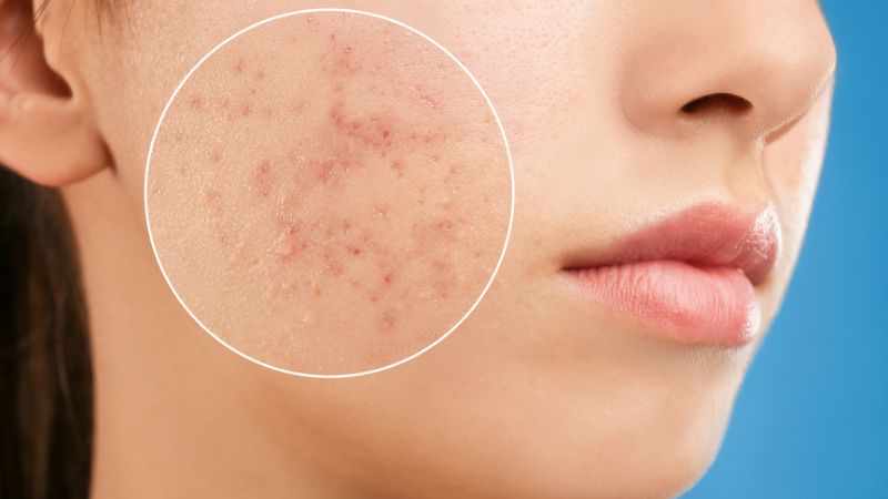 Nổi Mụn Khi Mang Thai Là Trai Hay Gái?