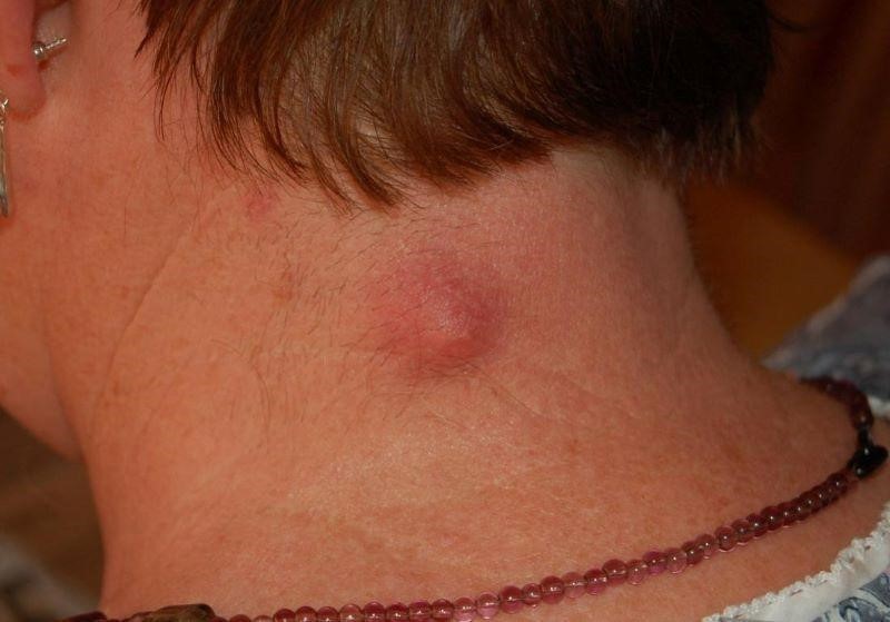Nổi Mụn Ở Gáy: Nguyên Nhân, Cách Điều Trị Và Phòng Ngừa