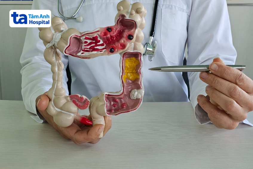Nối ruột bao lâu thì lành?