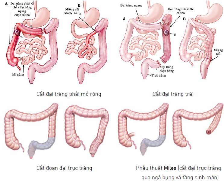 Nối ruột bao lâu thì lành? Gallery 2