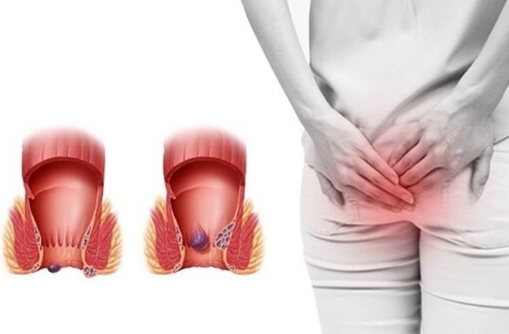 Nóng Rát Hậu Môn Sau Khi Đại Tiện