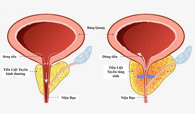 Nốt Vôi Hóa Tiền Liệt Tuyến: Nguyên Nhân, Triệu Chứng Và Điều Trị