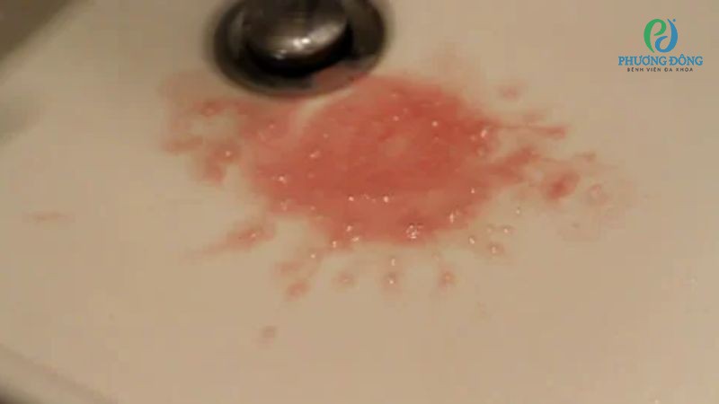 Nước Bọt Có Máu Đục: Nguyên Nhân Và Cách Xử Lý