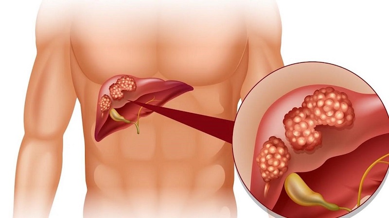 Nước Tiểu Đục Có Mùi Hôi: Nguyên Nhân Và Cách Khắc Phục