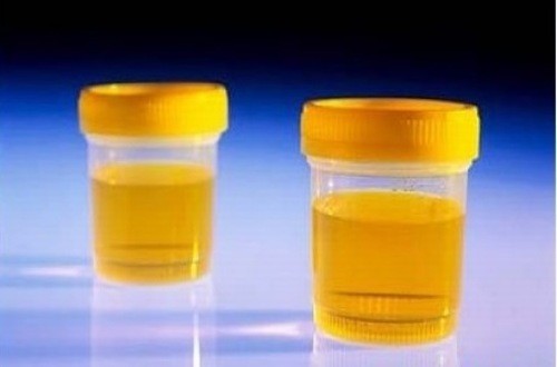 Nước Tiểu Màu Vàng Sẫm: Nguyên Nhân Và Cách Khắc Phục