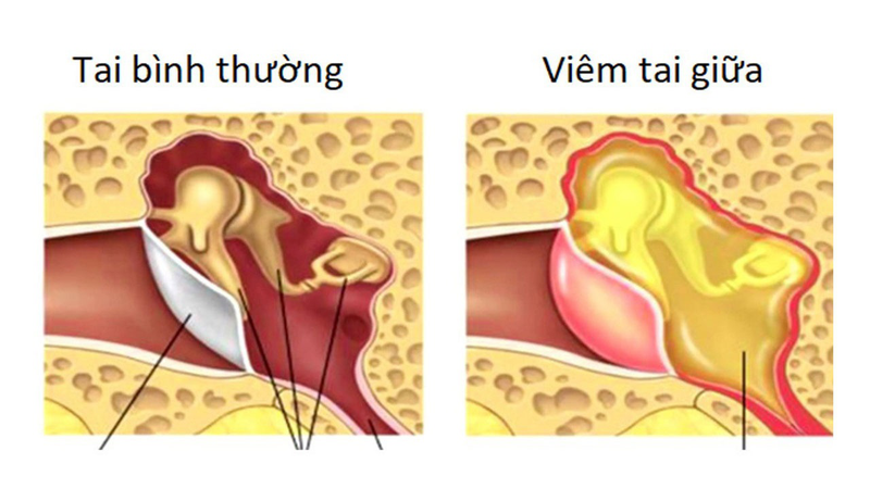 Nước vào tai có bị điếc không?