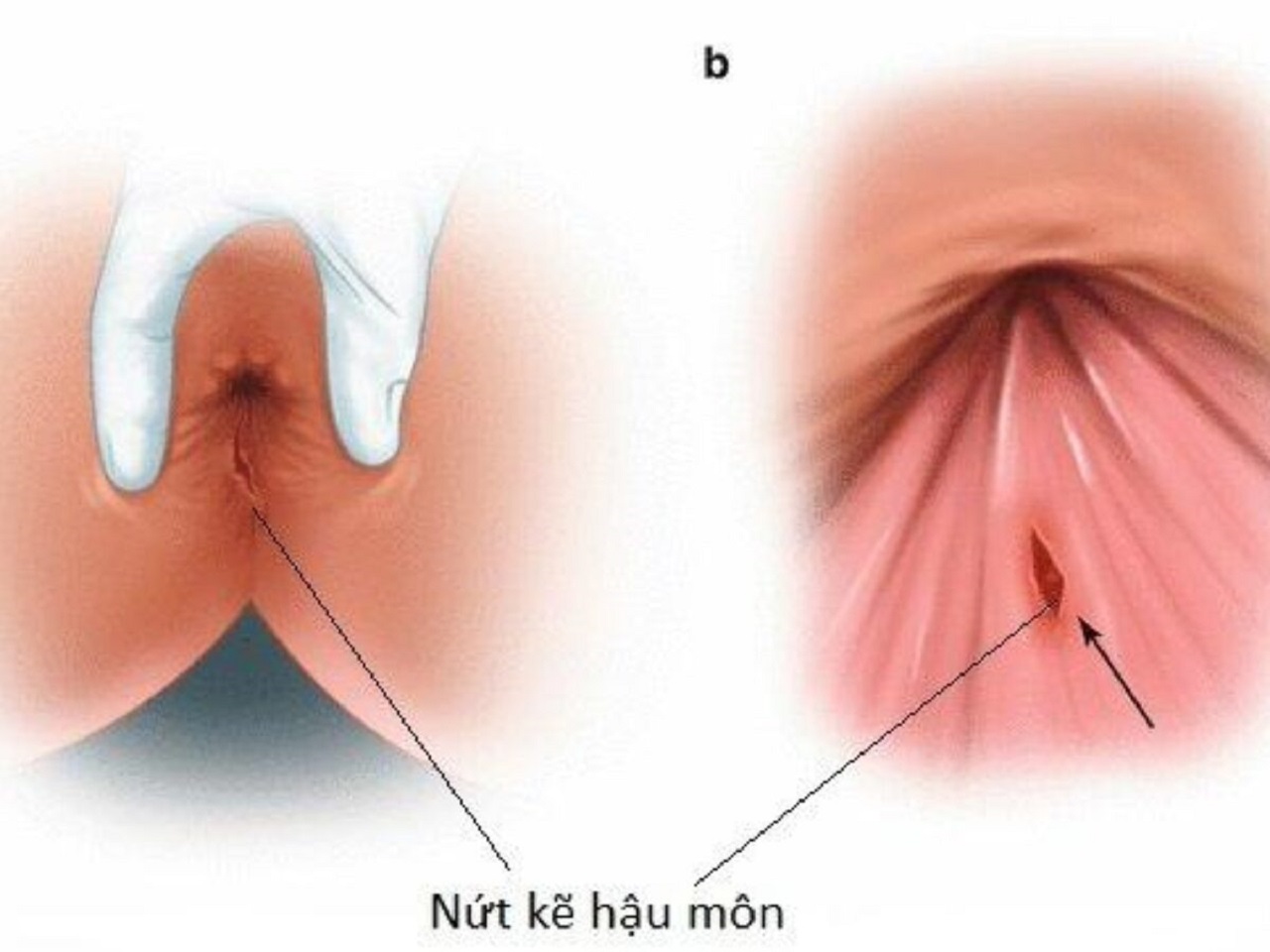 Nứt Hậu Môn Bao Lâu Thì Lành?