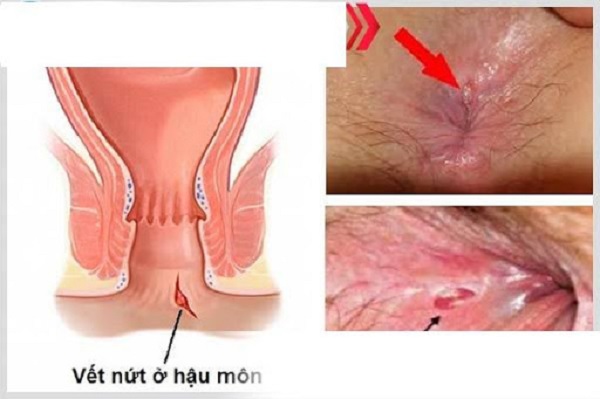 Nứt Hậu Môn Là Gì?