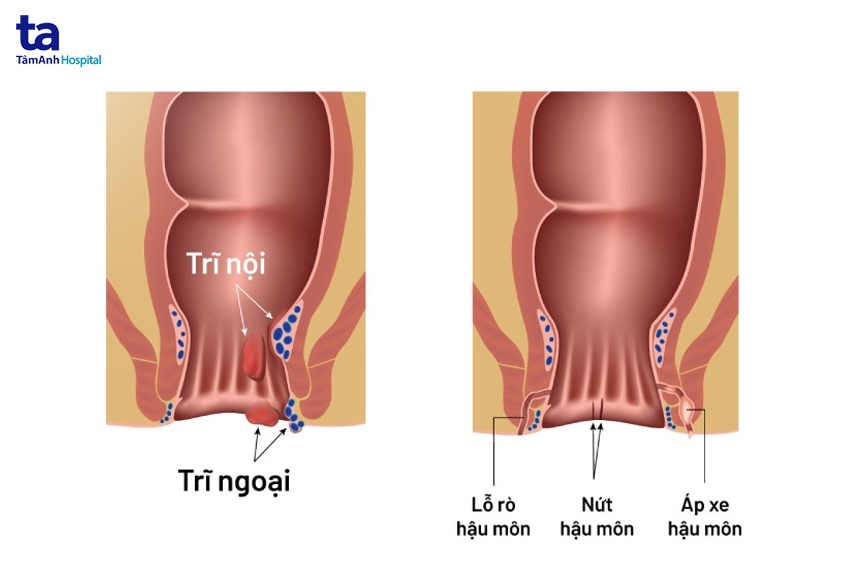 Nứt hậu môn làm sao hết?