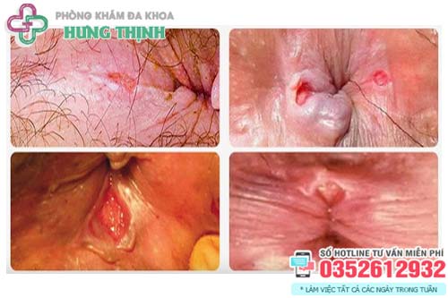 Nứt Kẽ Hậu Môn: Nguyên Nhân, Triệu Chứng Và Cách Điều Trị