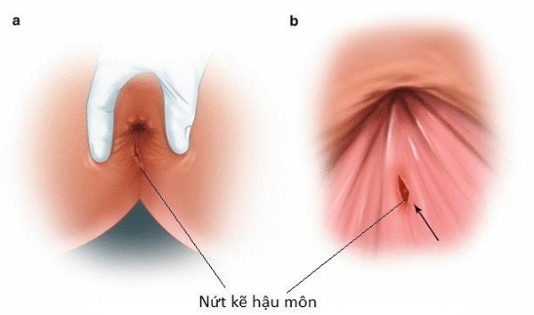 Nứt Kẽ Hậu Môn Bao Lâu Thì Khỏi? Gallery 2