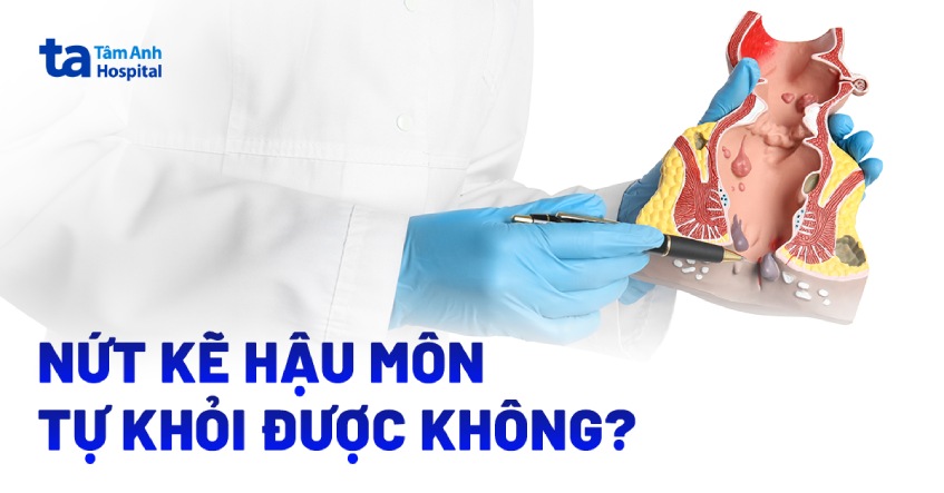 Nứt kẽ hậu môn có tự khỏi được không? Gallery 2