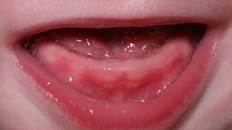 Nứt Lợi Mọc Răng Ở Trẻ