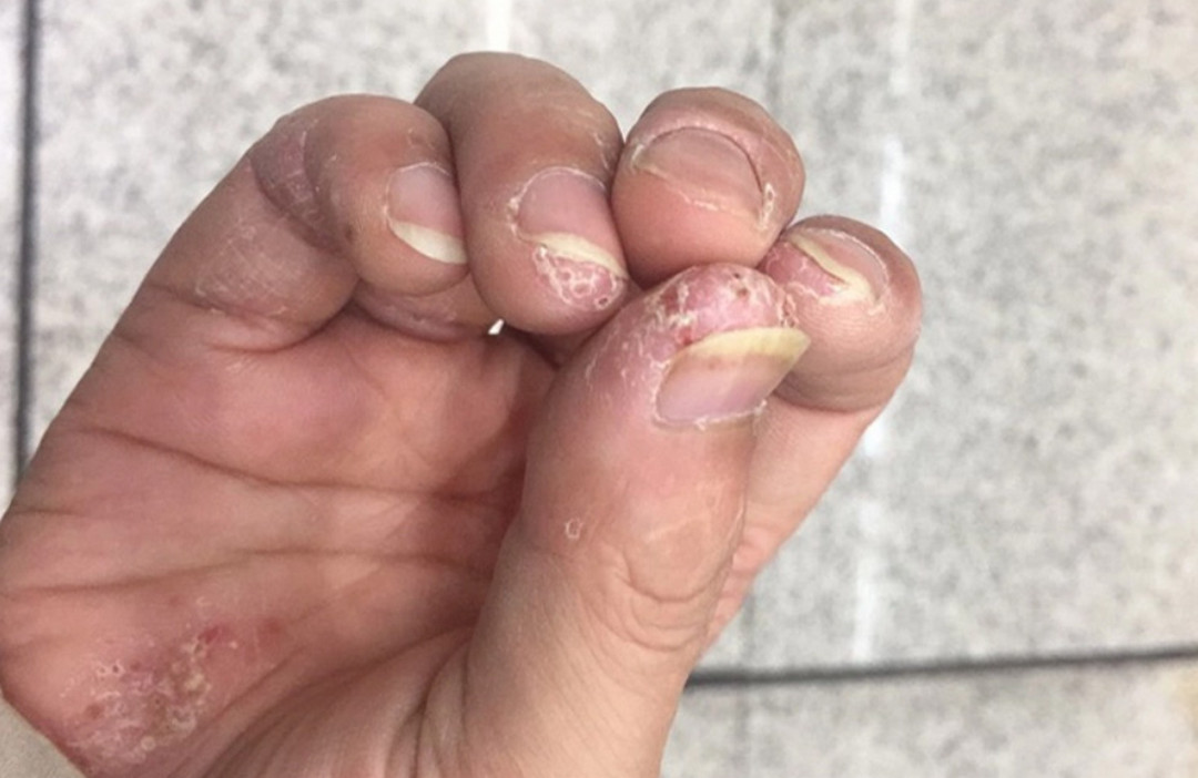 Nứt Nẻ Đầu Ngón Tay: Nguyên Nhân, Cách Điều Trị Và Phòng Ngừa
