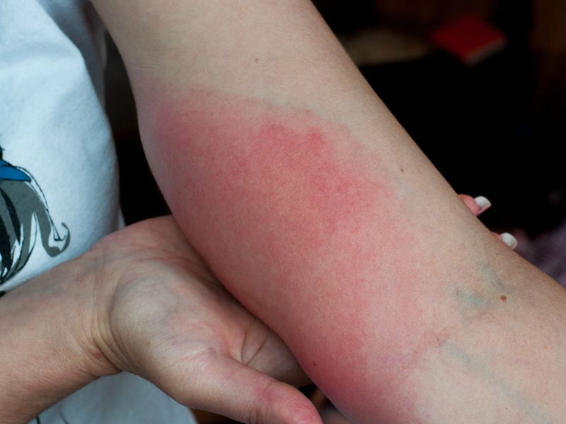 Ong chích bị ngứa: Cách xử lý và phòng ngừa