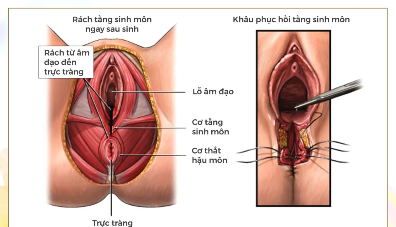 Vết Khâu Tầng Sinh Môn Bị Rách Phải Làm Sao? Gallery 2