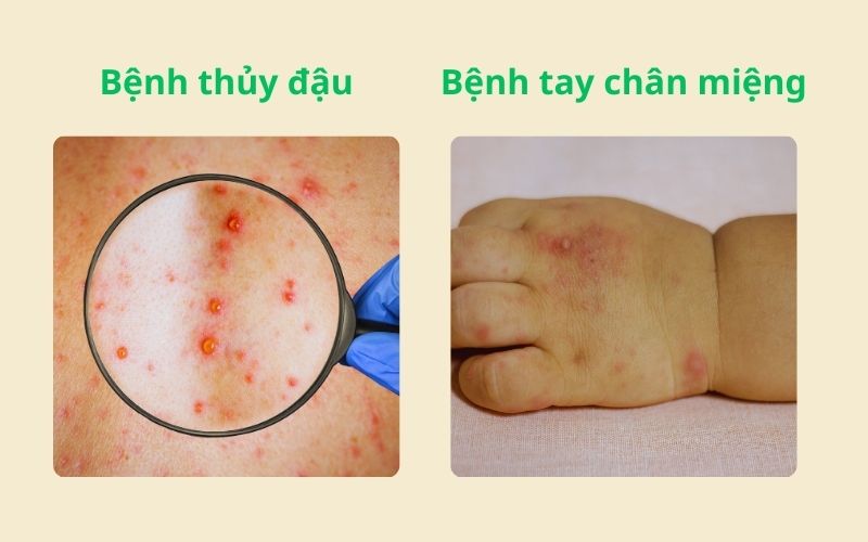 Phân biệt Tay Chân Miệng và Thủy Đậu