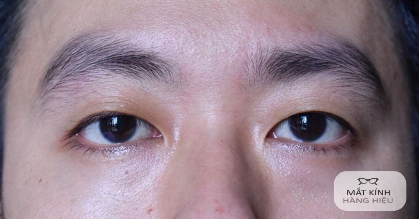 Trống mắt hay Chống mắt? Gallery 1