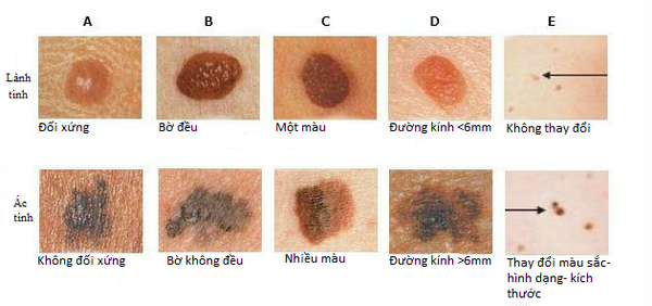 Mụn Ruồi Từ Đâu Mà Có? Gallery 2