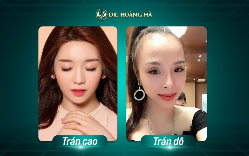 Người Trán Cao: Đặc Điểm, Tính Cách Và Những Điều Thú Vị Gallery 2