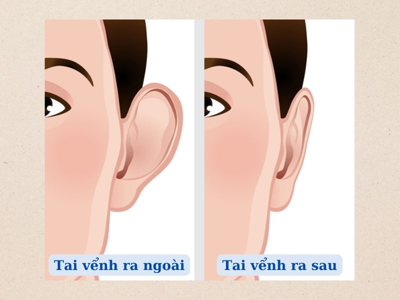 Tướng Tai Vểnh Ra Ngoài Gallery 1