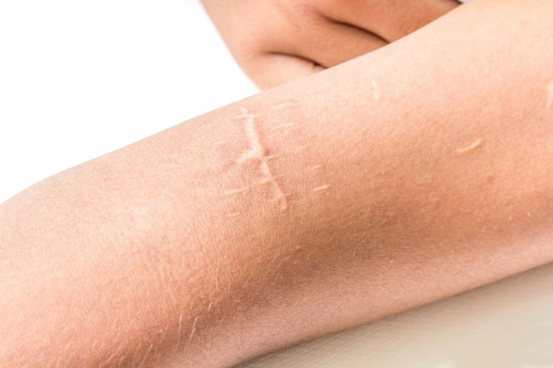 Phẫu thuật xóa sẹo trắng