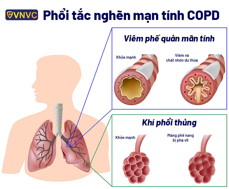 Phổi Tắc Nghẽn Mạn Tính Là Gì?