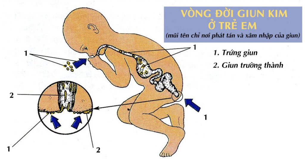 Cách Trị Giun Kim Ở Hậu Môn Cho Bé Gallery 2