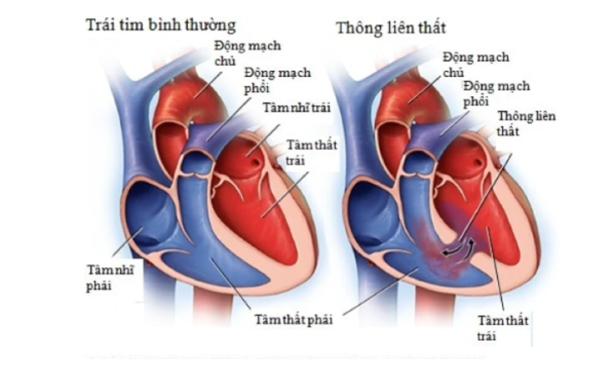 Tim thòng là gì? Gallery 2