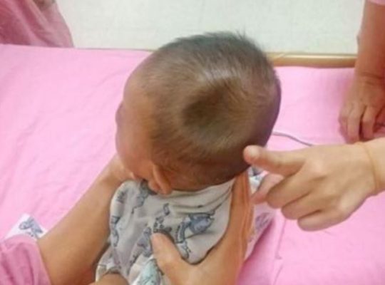 Trẻ Ngã Sưng Đầu: Cách Xử Trí Và Khi Nào Cần Đến Bệnh Viện Gallery 2