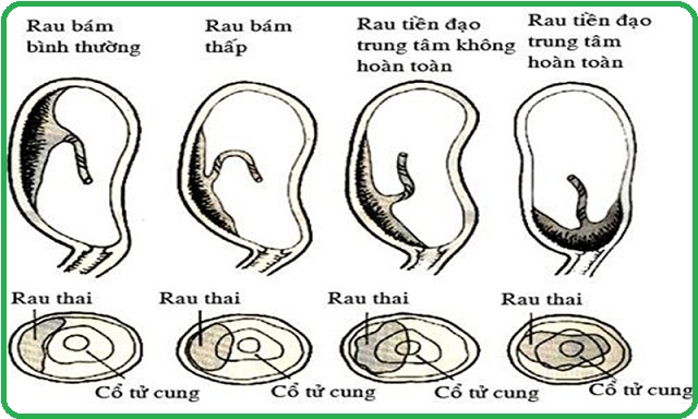 Nhau Bám Đáy Tử Cung Gallery 2