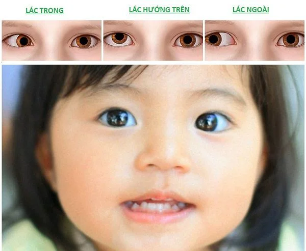 Mắt lác ngoài có chữa được không? Gallery 2